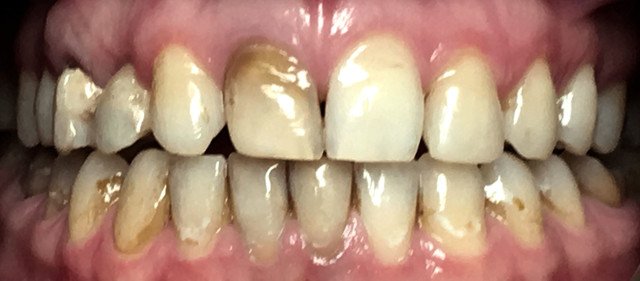Zęby pacjenta przed zmianą